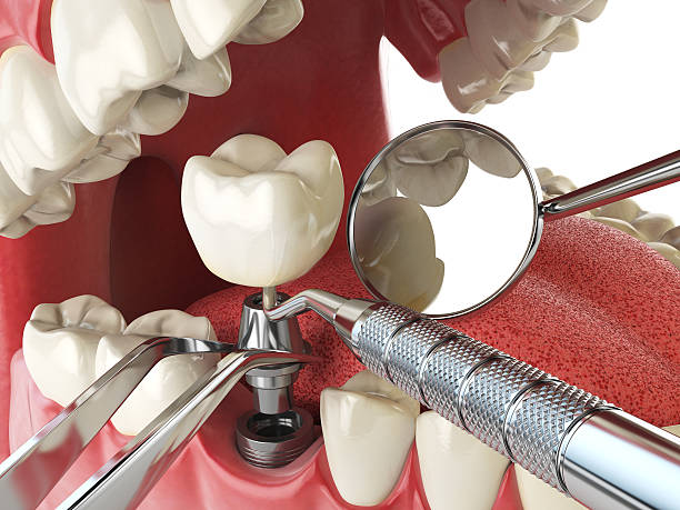 Best Emergency Dental Care for Broken or Chipped Teeth in Callaway, FL